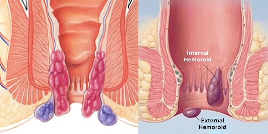 Hemoroid Nedir