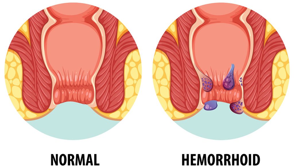 hemoroid ameliyatı