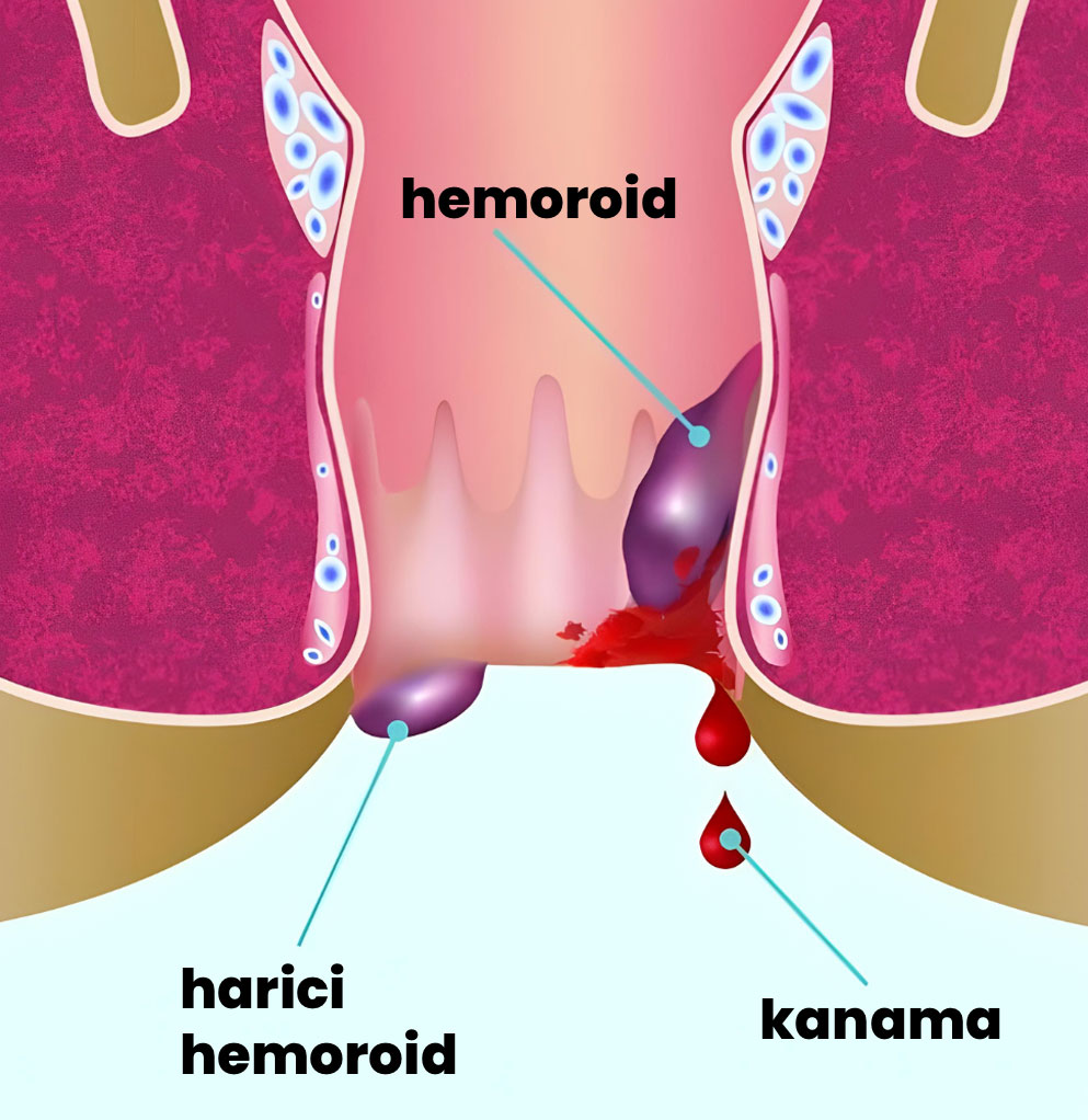 Dış Hemoroid